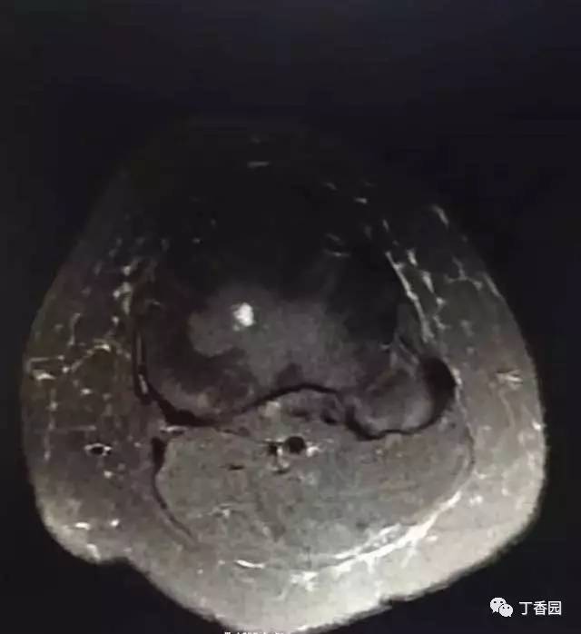 【病例】膝关节红骨髓转换1例MR
