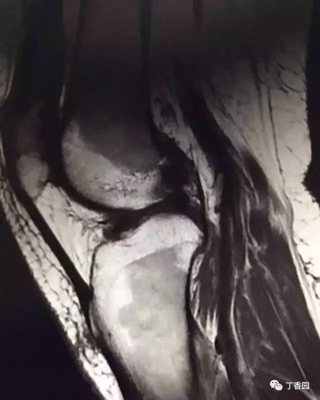 【病例】膝关节红骨髓转换1例MR