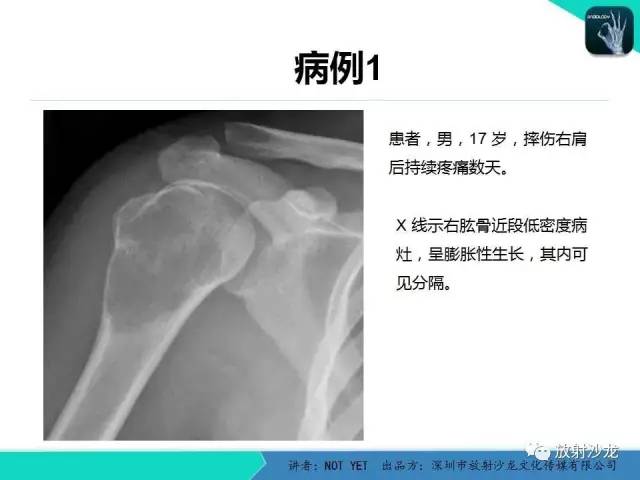 【病例】动脉瘤样骨囊肿2例X线MR影像表现
