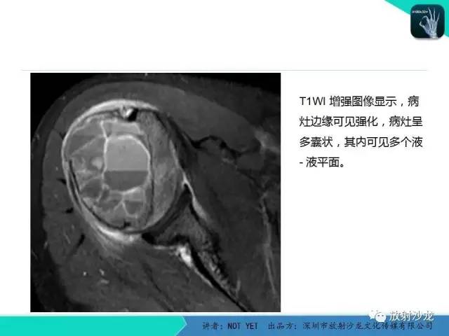 【病例】动脉瘤样骨囊肿2例X线MR影像表现