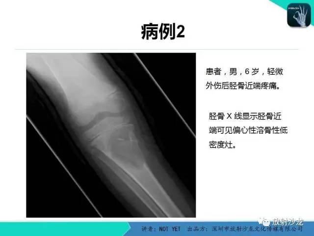 【病例】动脉瘤样骨囊肿2例X线MR影像表现