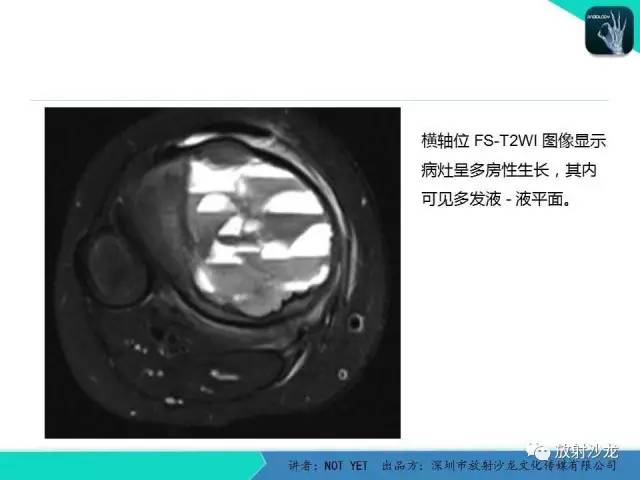 【病例】动脉瘤样骨囊肿2例X线MR影像表现