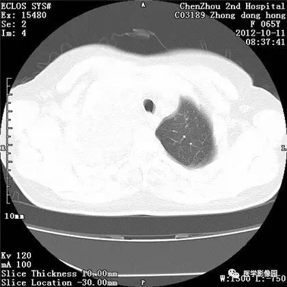 【病例】巨大肺错构瘤1例CT影像表现 【病例】巨大肺错构瘤1例CT影像表现