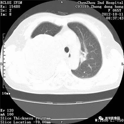【病例】巨大肺错构瘤1例CT影像表现 【病例】巨大肺错构瘤1例CT影像表现