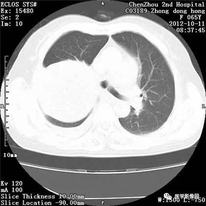 【病例】巨大肺错构瘤1例CT影像表现 【病例】巨大肺错构瘤1例CT影像表现