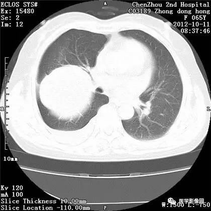 【病例】巨大肺错构瘤1例CT影像表现 【病例】巨大肺错构瘤1例CT影像表现