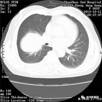 【病例】巨大肺错构瘤1例CT影像表现 【病例】巨大肺错构瘤1例CT影像表现