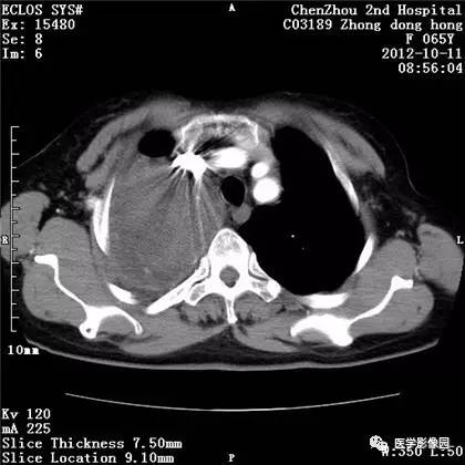 【病例】巨大肺错构瘤1例CT影像表现 【病例】巨大肺错构瘤1例CT影像表现