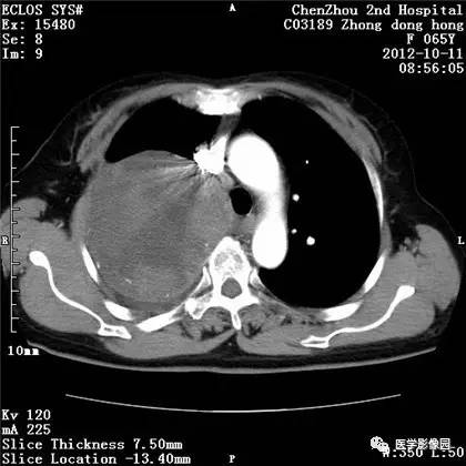 【病例】巨大肺错构瘤1例CT影像表现 【病例】巨大肺错构瘤1例CT影像表现