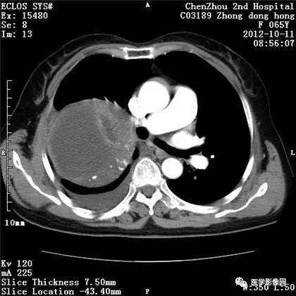 【病例】巨大肺错构瘤1例CT影像表现 【病例】巨大肺错构瘤1例CT影像表现