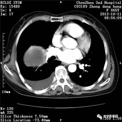 【病例】巨大肺错构瘤1例CT影像表现 【病例】巨大肺错构瘤1例CT影像表现