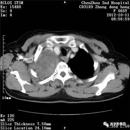 【病例】巨大肺错构瘤1例CT影像表现 【病例】巨大肺错构瘤1例CT影像表现