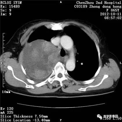 【病例】巨大肺错构瘤1例CT影像表现 【病例】巨大肺错构瘤1例CT影像表现