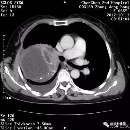 【病例】巨大肺错构瘤1例CT影像表现 【病例】巨大肺错构瘤1例CT影像表现
