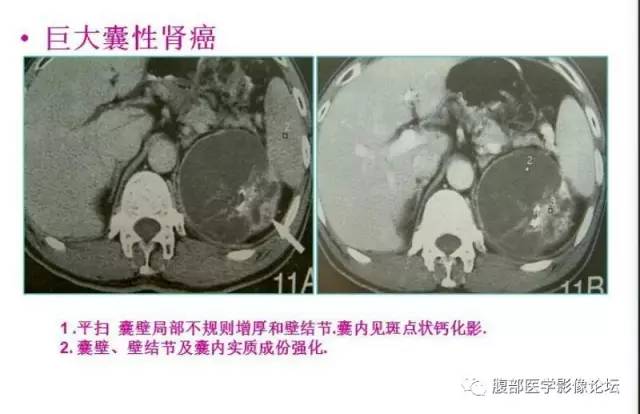【病例】囊性肾癌1例CT影像表现