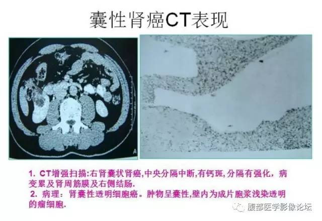 【病例】囊性肾癌1例CT影像表现