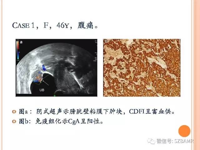 【PPT】膀胱副神经节瘤临床病理与影像