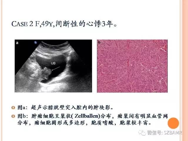 【PPT】膀胱副神经节瘤临床病理与影像
