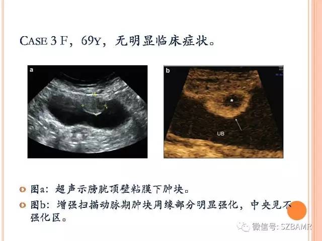 【PPT】膀胱副神经节瘤临床病理与影像