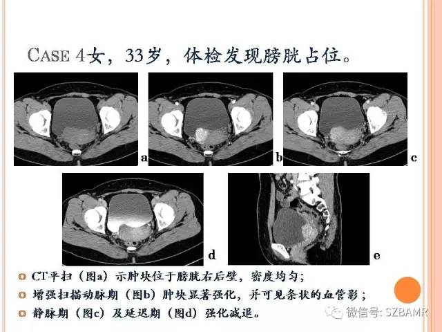 【PPT】膀胱副神经节瘤临床病理与影像