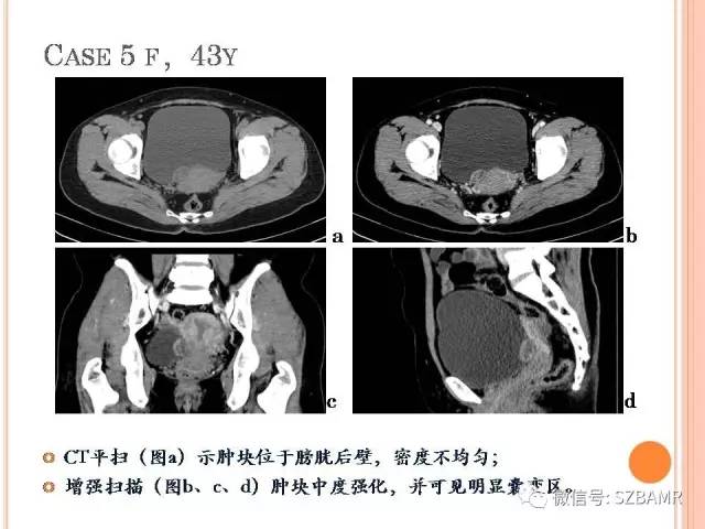 【PPT】膀胱副神经节瘤临床病理与影像