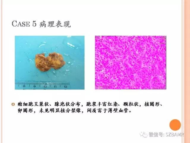 【PPT】膀胱副神经节瘤临床病理与影像