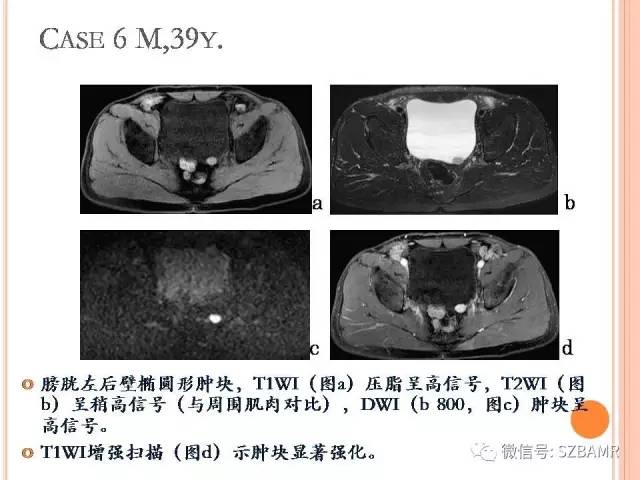 【PPT】膀胱副神经节瘤临床病理与影像
