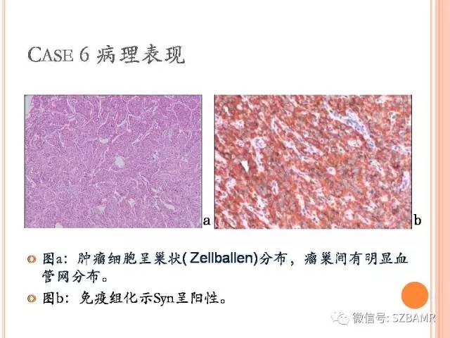 【PPT】膀胱副神经节瘤临床病理与影像