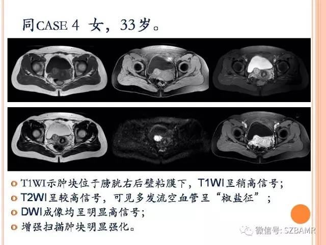 【PPT】膀胱副神经节瘤临床病理与影像