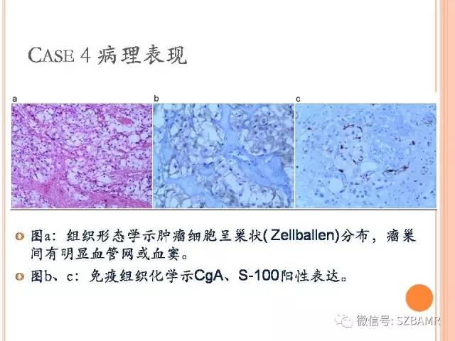 【PPT】膀胱副神经节瘤临床病理与影像