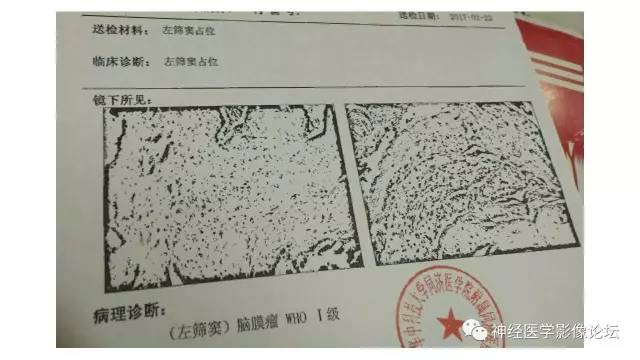 【病例】筛窦异位脑膜瘤一例MR