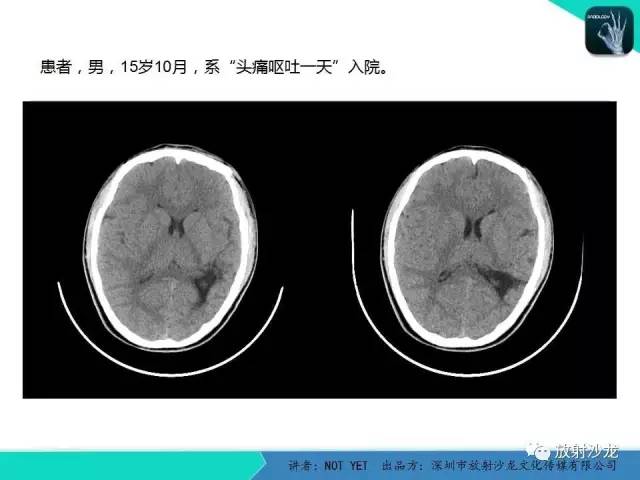 【病例】脑穿通畸形1例CT影像表现