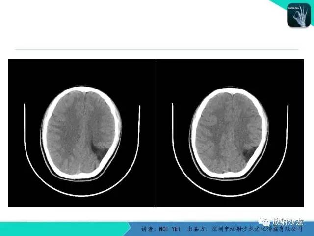 【病例】脑穿通畸形1例CT影像表现