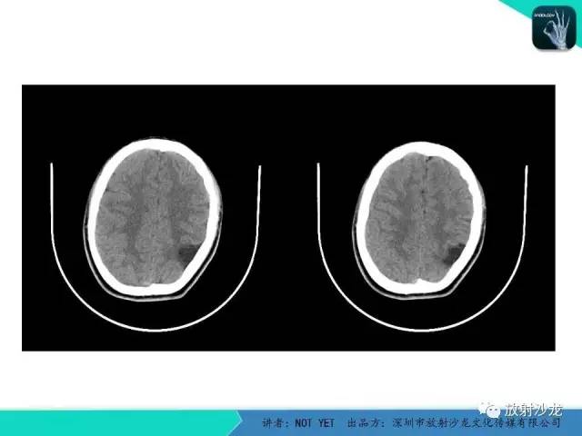 【病例】脑穿通畸形1例CT影像表现