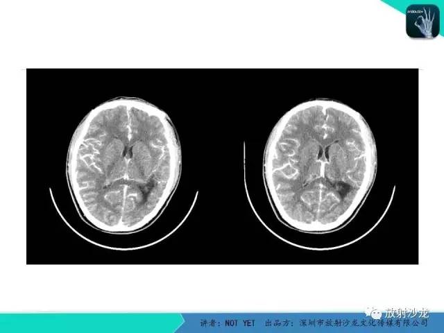 【病例】脑穿通畸形1例CT影像表现