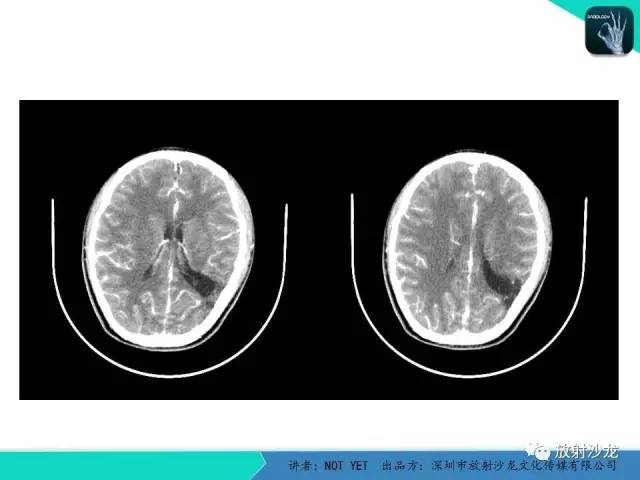 【病例】脑穿通畸形1例CT影像表现