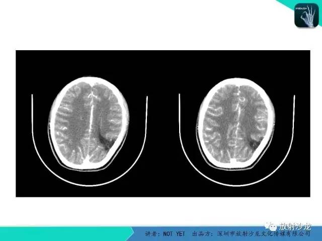 【病例】脑穿通畸形1例CT影像表现