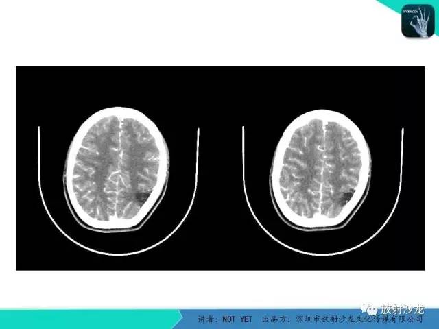 【病例】脑穿通畸形1例CT影像表现