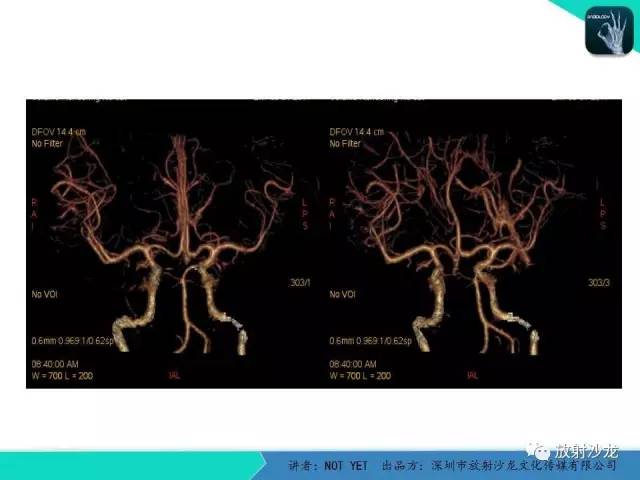【病例】脑穿通畸形1例CT影像表现