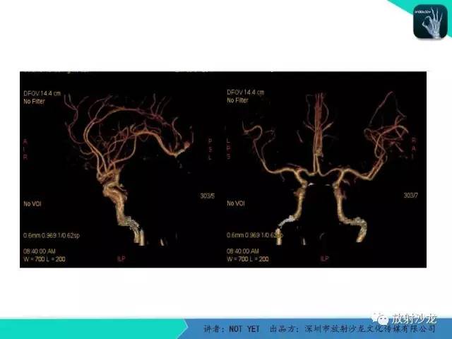 【病例】脑穿通畸形1例CT影像表现