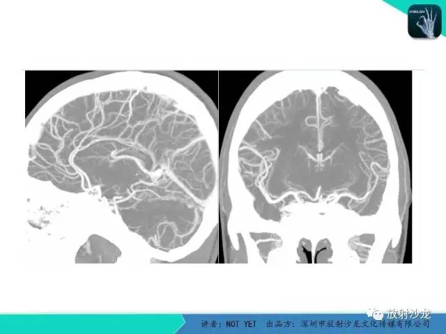 【病例】脑穿通畸形1例CT影像表现