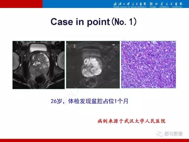 【PPT】前列腺肉瘤的MRI特征与临床病理分析