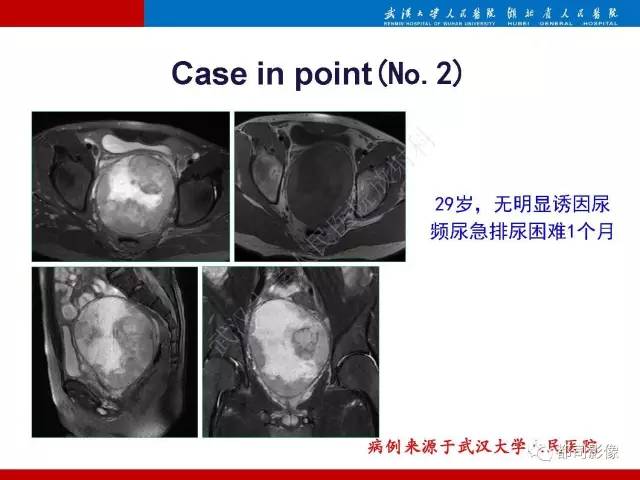 【PPT】前列腺肉瘤的MRI特征与临床病理分析