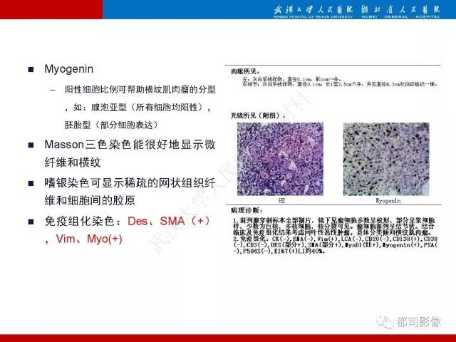 【PPT】前列腺肉瘤的MRI特征与临床病理分析
