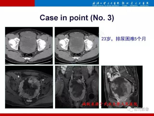 【PPT】前列腺肉瘤的MRI特征与临床病理分析