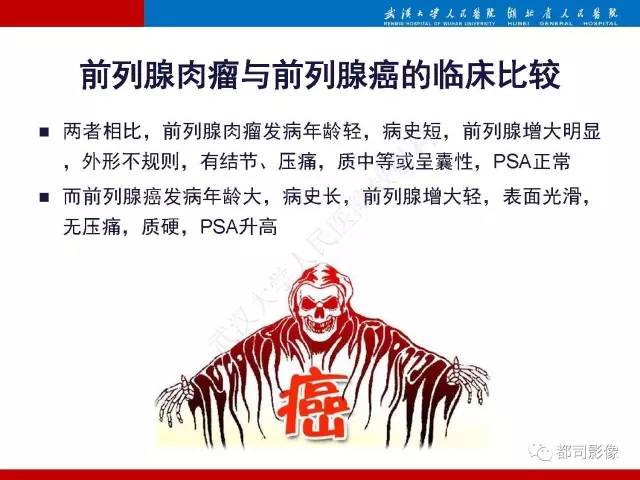 【PPT】前列腺肉瘤的MRI特征与临床病理分析