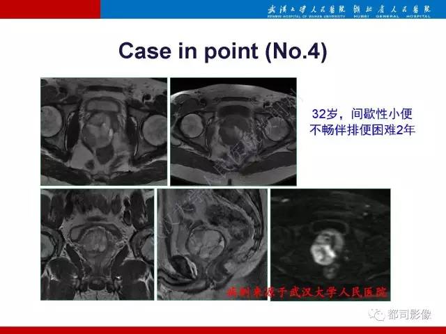 【PPT】前列腺肉瘤的MRI特征与临床病理分析