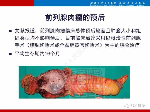【PPT】前列腺肉瘤的MRI特征与临床病理分析