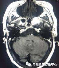 【病例】小脑蚓部淋巴瘤1例MR影像表现 【病例】小脑蚓部淋巴瘤1例MR影像表现
