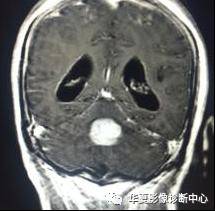 【病例】小脑蚓部淋巴瘤1例MR影像表现 【病例】小脑蚓部淋巴瘤1例MR影像表现